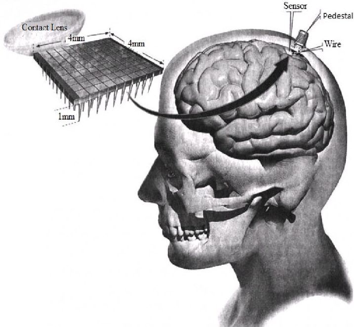 A silicon chip implanted in the brain cortex through pedestal